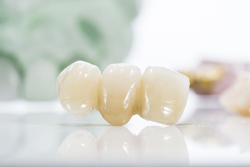 Common Problems With Dental Bridges