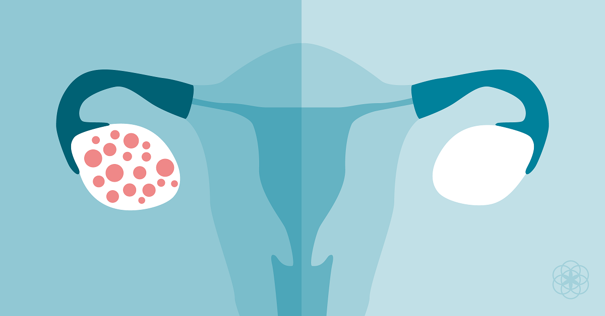PCOS (Polycystic Ovarian Syndrome) - Cure and Tips