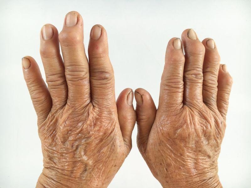 Treatement  of deformities 