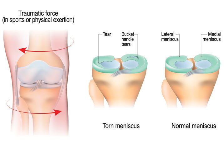 What is meniscus injury,How it occurs,Pecaution should be taken,Treatement of meniscus injury