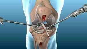 What is Anterior Cruciate Ligament treatemet,How it s diagnosed,Precaution should be taken after ACL