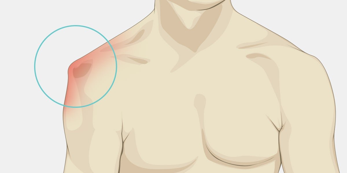 What Bankart (shoulder disclocation), Bankart (shoulder disclocation),treatement for  Bankart (shoul